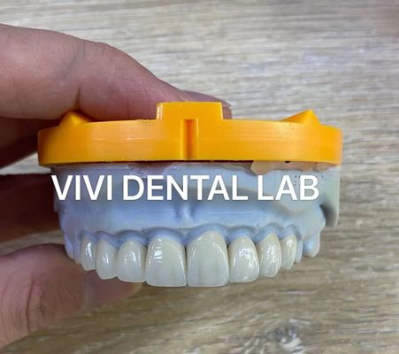 Ivoclar Emax Laminate Veneers Tự minh chuyên nghiệp Trung Quốc Phòng thí nghiệm nha khoa cấp cao