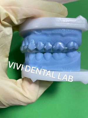 Nẹp nha khoa Michigan ổn định với sự phù hợp hoàn hảo và chất lượng chuyên nghiệp