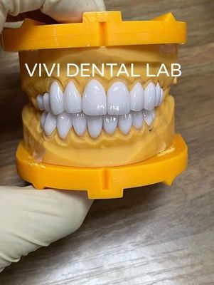 Super White E Max Laminate Veneers Nha khoa chuyên nghiệp thẩm mỹ cao