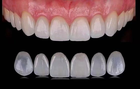 Tranlucent Emax Laminate Veneers / Porcelain Dental Veneers ISO được phê duyệt