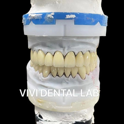 CAD CAM kỹ thuật số Vương miện phòng thí nghiệm nha khoa Trò xuyên suốt Lớp vương miện Zirconia