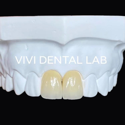 Toàn hàm nha khoa Zirconia cầu cấy ghép vương miện xuyên suốt thẩm mỹ