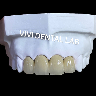 PFM Vương miện phòng thí nghiệm nha khoa kỹ thuật SLM với bột hợp kim Scheftner 30