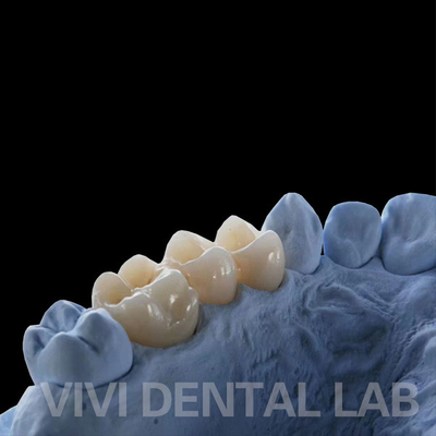 Full Contour Vương miện phòng thí nghiệm nha khoa xuyên suốt cao Vương miện Zirconia rắn