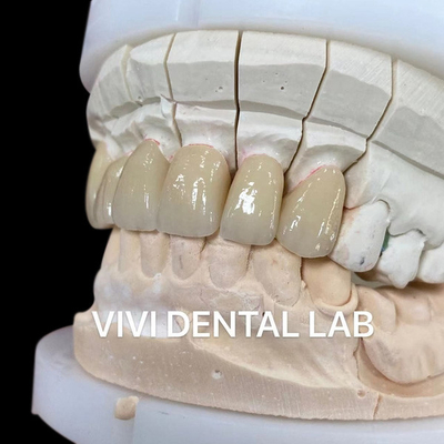 Một lớp vương miện phòng thí nghiệm nha khoa viễn vọng Zirconia Noritake sứ