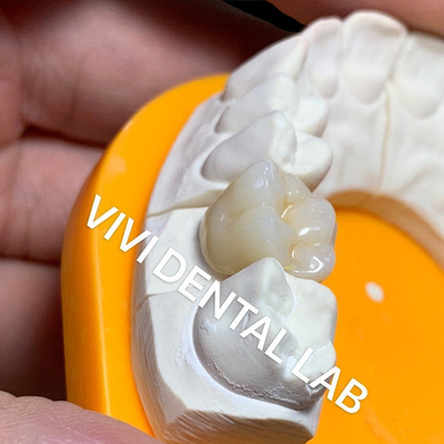 Vương miện phòng thí nghiệm nha khoa rắn 3D Pro Trò xuyên suốt đầy đủ Vương miện Zirconia Trung Quốc Phòng thí nghiệm nha khoa