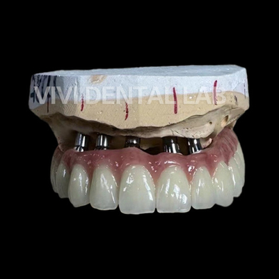 Total Implant PFM Bridge Trung Quốc phòng thí nghiệm nha khoa