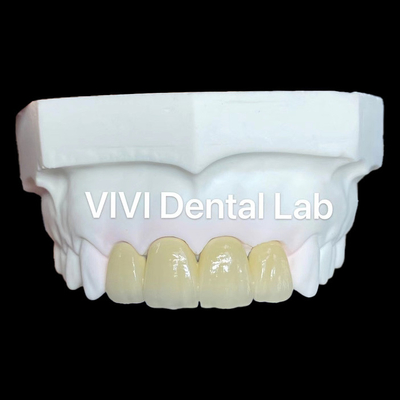Vương miện Zirconia PFZ Vương miện Zirconia Porcelain Vương miện răng