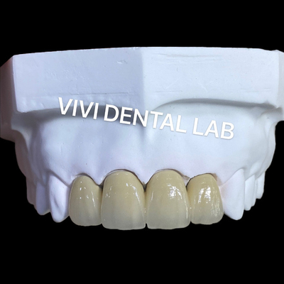 Vương miện kim loại gốm PFM Vương miện và cầu từ Phòng thí nghiệm nha khoa Trung Quốc