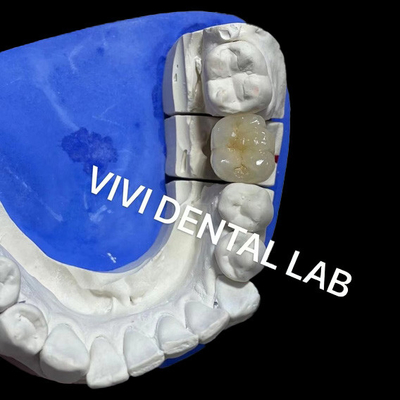 Ivoclar Scheftner kim loại sứ vương miện kim loại gốm vương miện Ni miễn phí