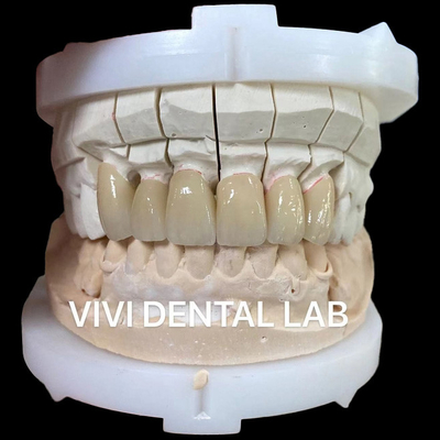 Lớp Zriconia Porcelain kim loại nóng chảy vương miện trong bóng tốt