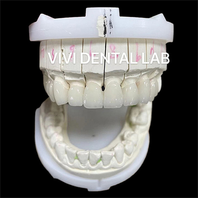 Phong cách thẩm mỹ cao Zirconia răng phòng thí nghiệm vương miện cầu với lớp sứ