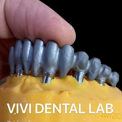 Cây cầu PFM được in trên nhiều đơn vị từ Phòng thí nghiệm nha khoa Trung Quốc