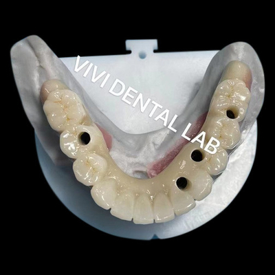Multilayer Zirconia vít giữ cầu tương thích sinh học trên cấu trúc kim loại