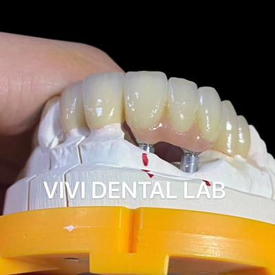 Porcelain Zirconia Dental Implant Bridge chuyên nghiệp thẩm mỹ cao
