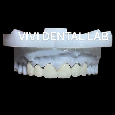 Dental Anterior Zirconia Bridge ISO chứng nhận thời gian quay nhanh