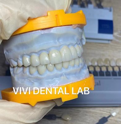 Răng thẩm mỹ cao Emax Laminate Veneers Incisal Translucency Trung Quốc Phòng thí nghiệm nha khoa