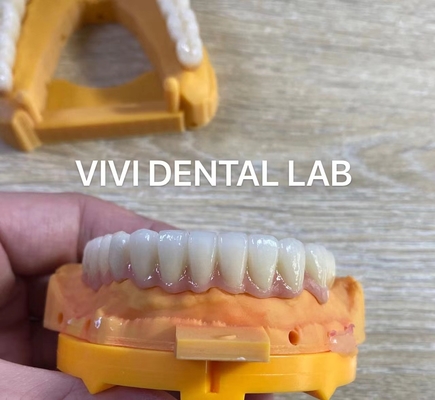 Toàn hàm nha khoa Zirconia cầu cấy ghép vương miện xuyên suốt thẩm mỹ