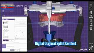 Nẹp nhai kỹ thuật số thoải mái chính xác