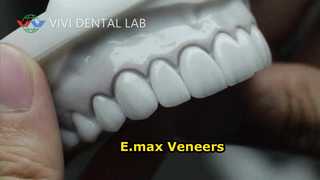 Veneers nha khoa
