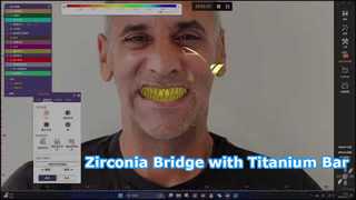 Giải pháp thanh titan Zirconia Bridge All on X